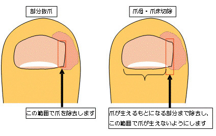 爪母切除