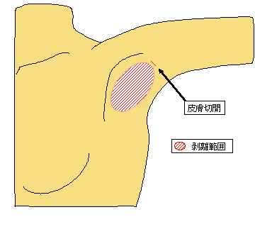 超音波吸引法