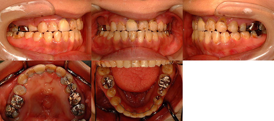 口唇口蓋裂の治療例　左側唇顎口蓋裂に起因する顔面非対称を呈する骨格性下顎前突　動的治療終了時　口腔内