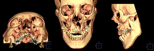 口唇口蓋裂の治療例　左側唇顎口蓋裂に起因する顔面非対称を呈する骨格性下顎前突　初診時　顔面３ＤＣＴ