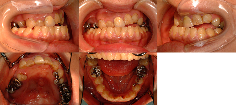 口唇口蓋裂の治療例　左側唇顎口蓋裂に起因する顔面非対称を呈する骨格性下顎前突　初診時　口腔内