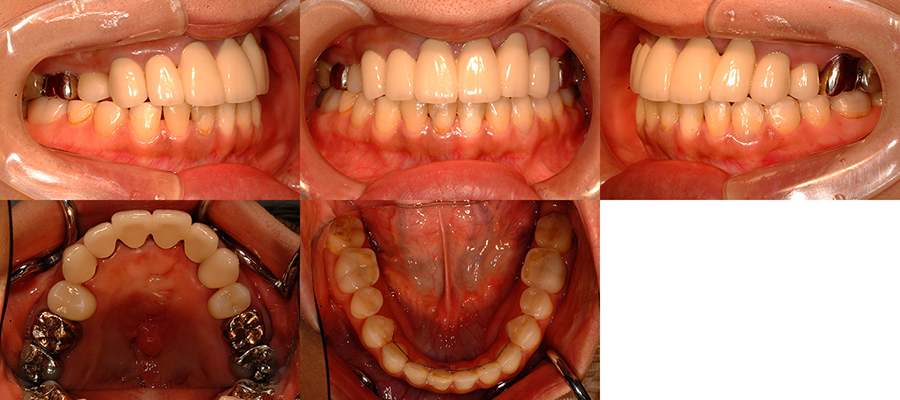 口唇口蓋裂の治療例　左側唇顎口蓋裂に起因する顔面非対称を呈する骨格性下顎前突　補綴治療後　口腔内