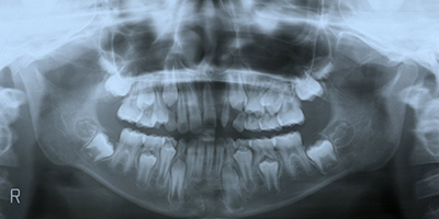口唇口蓋裂の治療例（Ⅰ期治療）　左側口唇顎裂に起因する上顎前歯部叢生　動的治療終了時　パントモ