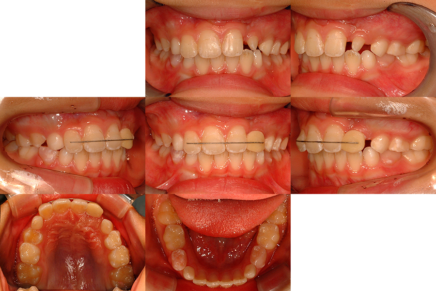 口唇口蓋裂の治療例（Ⅰ期治療）　左側口唇顎裂に起因する上顎前歯部叢生　動的治療終了時　口腔内