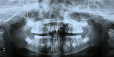 口唇口蓋裂の治療例（Ⅰ期治療）　左側口唇顎裂に起因する上顎前歯部叢生　初診時　パントモ