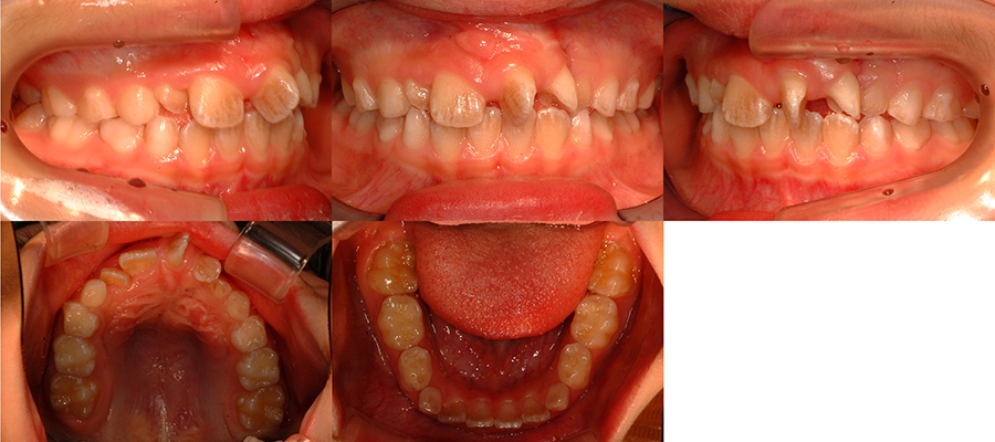 口唇口蓋裂の治療例（Ⅰ期治療）　左側口唇顎裂に起因する上顎前歯部叢生　初診時　口腔内