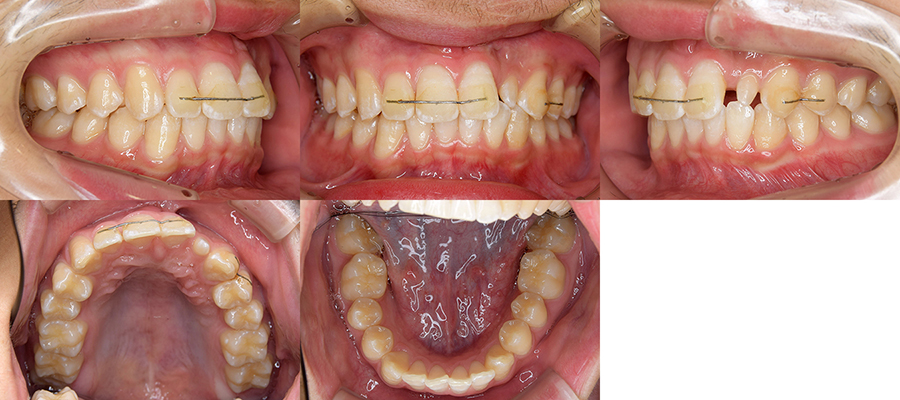 口唇口蓋裂の治療例（Ⅰ期治療）　左側口唇顎裂に起因する上顎前歯部叢生　保定中　口腔内