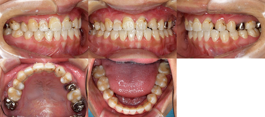 口唇口蓋裂の治療例　矯正治療の既往のある左側唇顎口蓋裂に起因する顔面非対称を呈する骨格性下顎前突に対する再治療として上下顎同時移動術を施行した口唇口蓋裂の治療例　動的治療終了時　口腔内