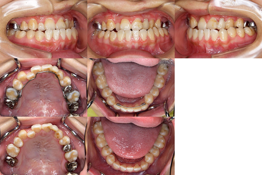 口唇口蓋裂の治療例　矯正治療の既往のある左側唇顎口蓋裂に起因する顔面非対称を呈する骨格性下顎前突に対する再治療として上下顎同時移動術を施行した口唇口蓋裂の治療例　初診時　口腔内