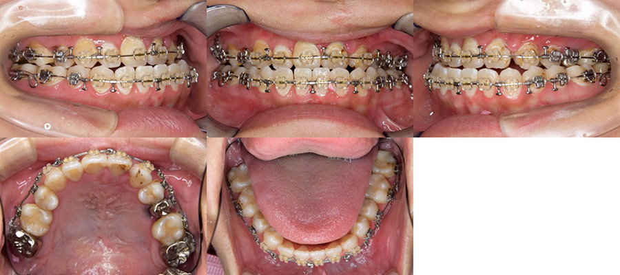 口唇口蓋裂の治療例　矯正治療の既往のある左側唇顎口蓋裂に起因する顔面非対称を呈する骨格性下顎前突に対する再治療として上下顎同時移動術を施行した口唇口蓋裂の治療例　顎矯正手術直前　口腔内