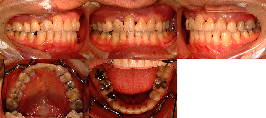 口唇口蓋裂の治療例　矯正治療の既往がある右側唇顎口蓋裂に起因する咬合不全に対する再治療症例　動的治療終了時　口腔内