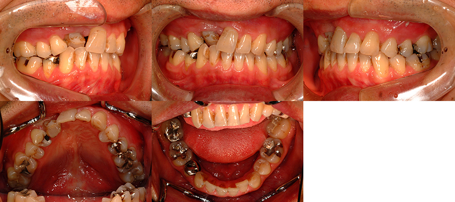 口唇口蓋裂の治療例　矯正治療の既往がある右側唇顎口蓋裂に起因する咬合不全に対する再治療症例　初診時　口腔内