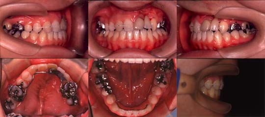 口唇口蓋裂の治療例　左側唇顎口蓋裂に起因する上顎歯列弓狭窄を伴う骨格性下顎前突　保定開始時