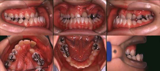 口唇口蓋裂の治療例　左側唇顎口蓋裂に起因する上顎歯列弓狭窄を伴う骨格性下顎前突　初診時