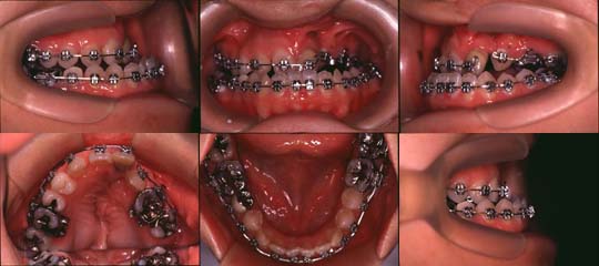 口唇口蓋裂の治療例　左側唇顎口蓋裂に起因する上顎歯列弓狭窄を伴う骨格性下顎前突　手術直前