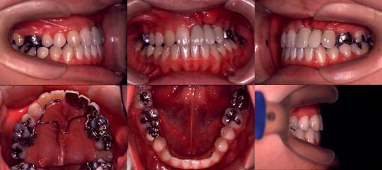 口唇口蓋裂の治療例　左側唇顎口蓋裂に起因する上顎歯列弓狭窄を伴う骨格性下顎前突　補綴終了時