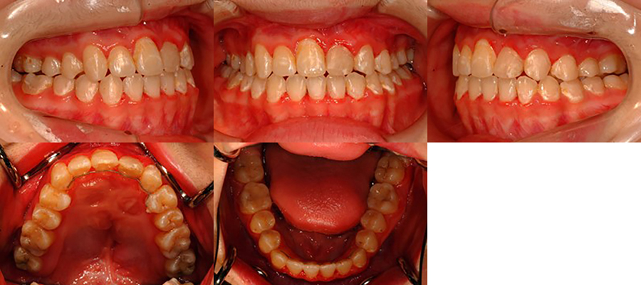 口唇口蓋裂の治療例　左側唇顎口蓋裂に起因する顔面非対称を伴う骨格性下顎前突　動的治療終了時　口腔内
