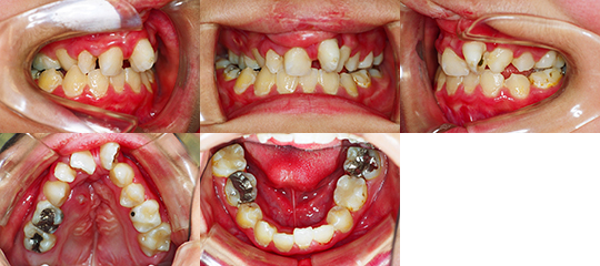 口唇口蓋裂の治療例（Ⅰ期治療）　両側性唇顎口蓋裂に起因する上顎歯列弓狭窄と叢生　初診時