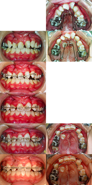 治療中～顎裂部骨移植前の拡大と排列