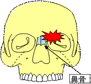 頬骨骨折