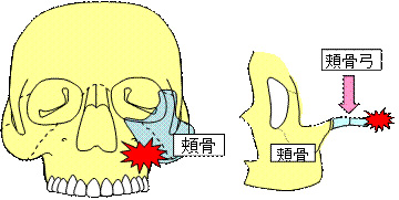 頬骨骨折