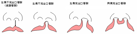 口唇裂・顎裂・口蓋裂